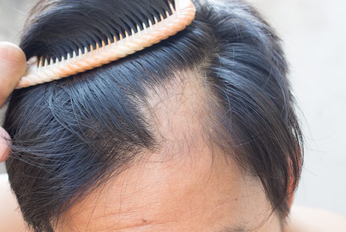 Specialist Dermatology Alopecia Female Hairloss Itchy Scalp Male Balding